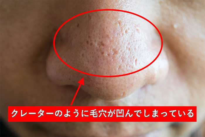 男性のいちご鼻の原因と治し方とは 黒ずみ毛穴が解消できるおすすめアイテムも紹介 Danlead